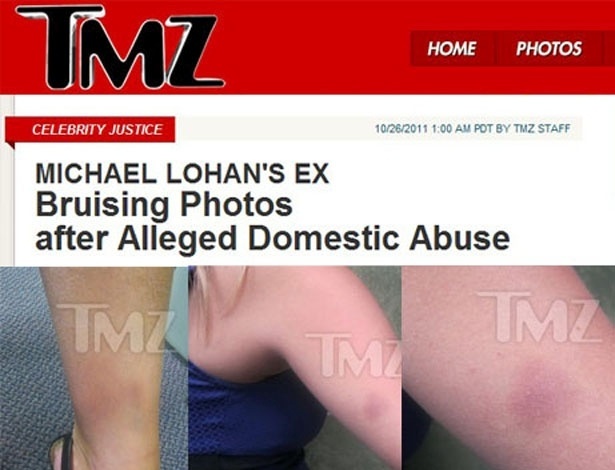 O site TMZ divulga fotos dos hematomas causados por Michael Lohan (26/10/11)